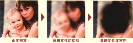 加齢黄斑変性症