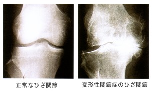 変形性関節症のレントゲン写真