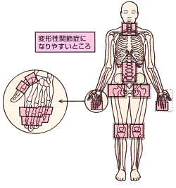 図解、変形性関節症にかかりやすいところ